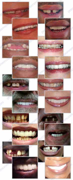 Press On Veneers client before & afters