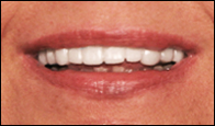 Laurie Hall After Press On Veneers