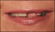 Laurie Hall Before Press On Veneers