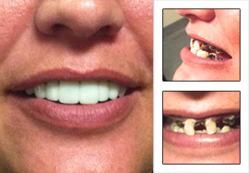 How To Take Proper Press On Veneers Pictures