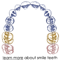 Press On Veneers designed to cover the smile teeth.