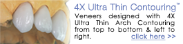 Press On Veneers 4X Ultra Thin Contouring