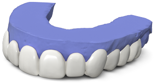 Press On Veneers veneers on mould